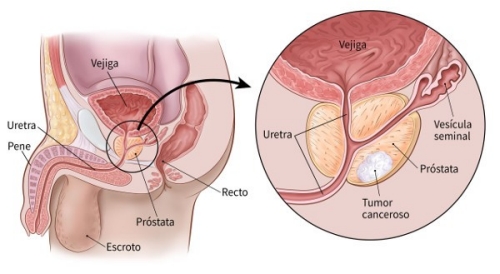 cáncer_prostata_¡